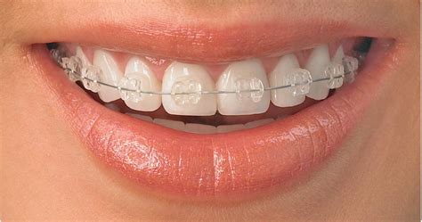 cual es mejor brackets metalicos o esteticos|champagne vs metal braces.